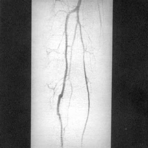 Postoperative Digital Subtraction Angiogram Showing Patency Of The