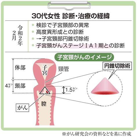 【がん電話相談から】子宮頸がんで妊娠希望 扁平上皮タイプで切除断端が陰性なら可能 産経ニュース