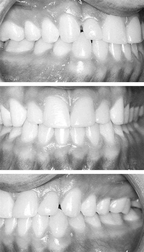 Treatment Of A Class Iii Malocclusion With Maxillary Constriction And