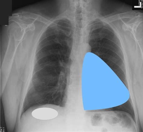 Chest X Rays Flashcards Quizlet