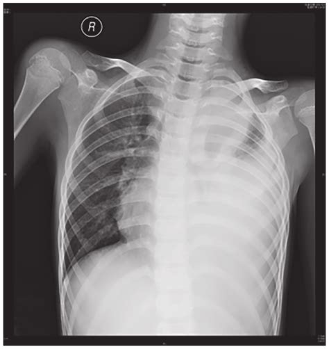 Chest X-ray of the proband, revealing left empyema. | Download Scientific Diagram