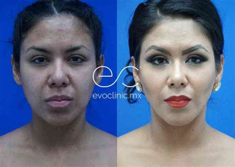 Guía completa de la liposucción facial Costo procedimiento y duración