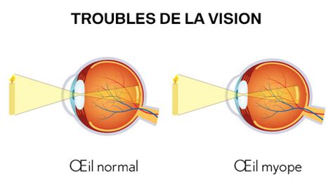 Comprendre La Myopie Causes Sympt Mes Et Traitements