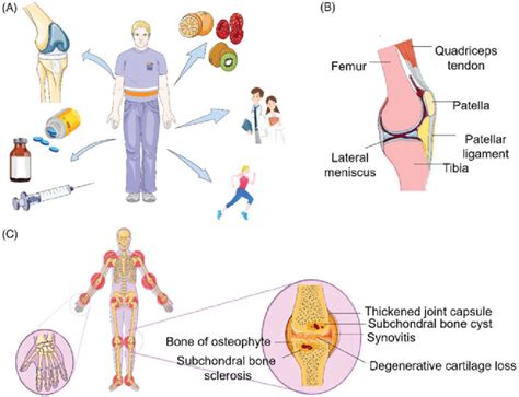 Osteoarthritis Treatment