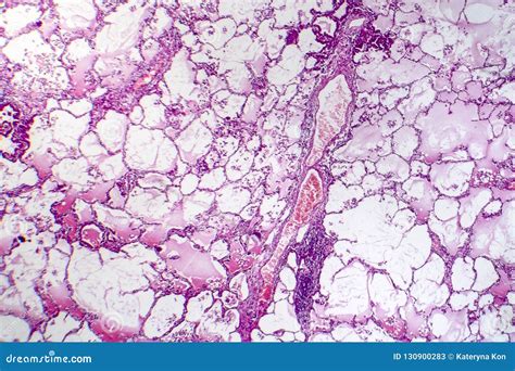 Lung Adenocarcinoma Stock Image Image Of Cell Microscopic