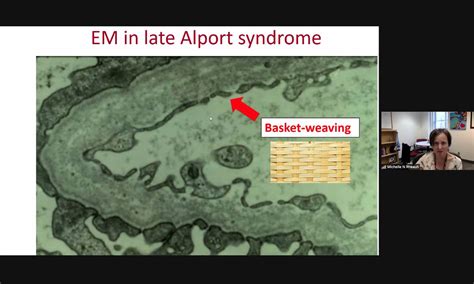 Alport Syndrome Basement Membrane