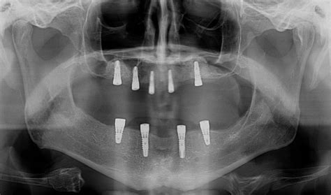 Upper And Lower Implant Overdentures Total Implants Male