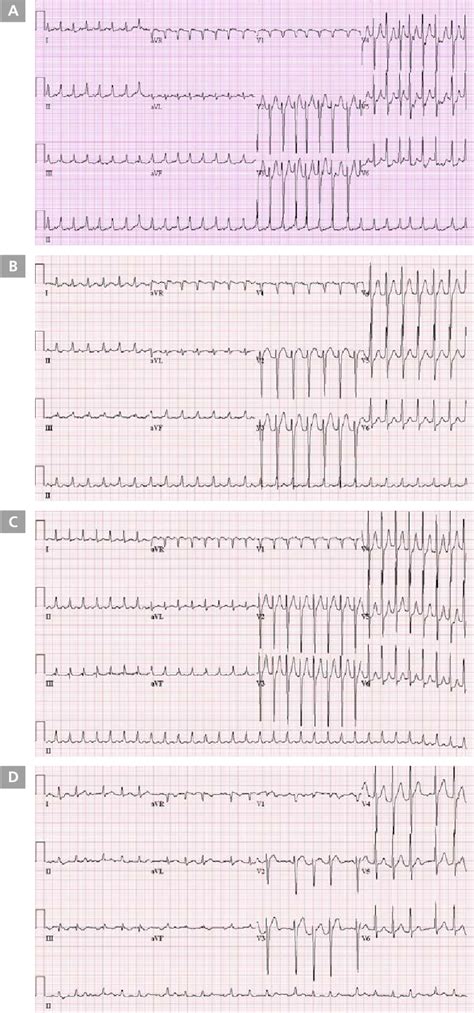 Figure 1 From Left Atrial Intramural Hematoma After Catheter Ablation