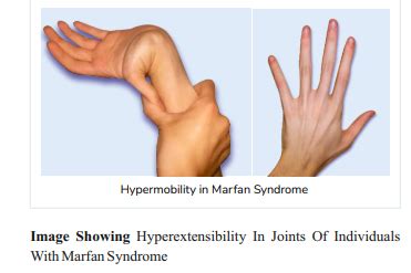 syndrome de marfan mains isaiah austin diagnosed  marfan syndrome