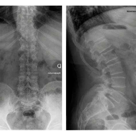 Preoperative Anteroposterior And Sagittal X Ray Spondylolisthesis