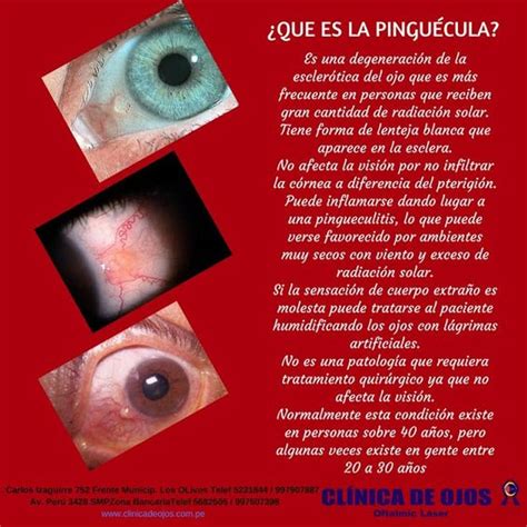 Clínica de Ojos Oftalmic Láser QUE ES LA PINGUÉCULA