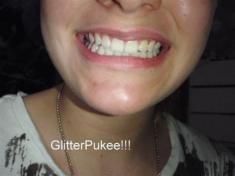 GLITTER PUKE!!: Whitening Lightning Teeth Whitening kit