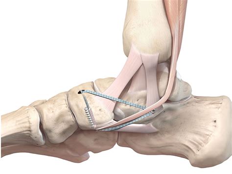 The Internal Brace Mackay Clinic