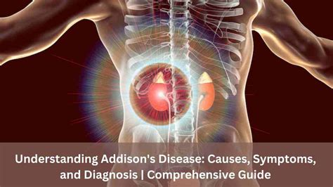 Understanding Addisons Disease Causes Symptoms