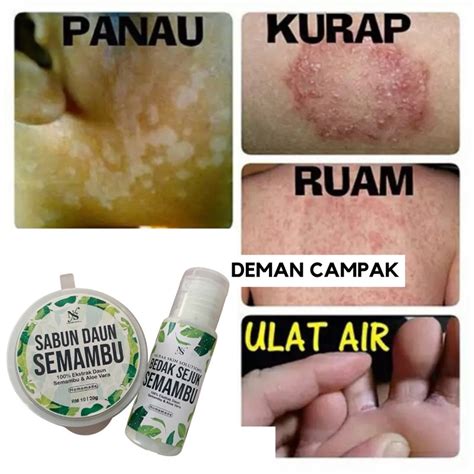 Bedak Gatal Semambu Neem Kayap Kudis Panau Ruam Kayap Air