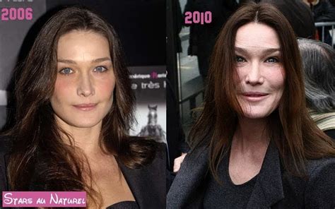 Stars au naturel Carla Bruni et la chirurgie esthétique La preuve en