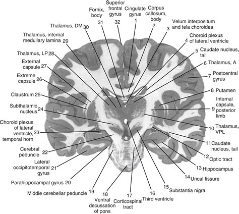 functional neuroanatomy   basal ganglia clinical tree