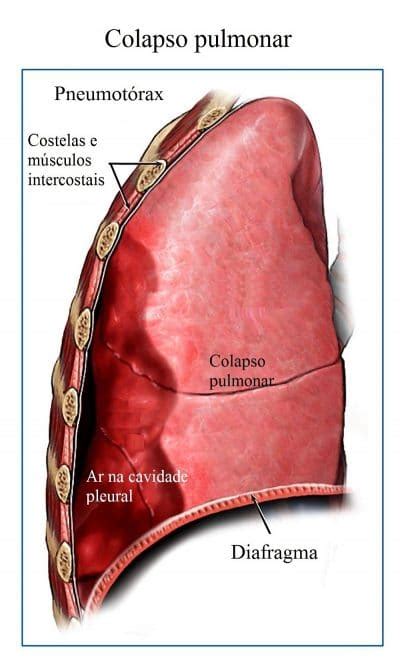 Fratura da costela no tòrax sintomas tratamento e tempo de recuperação