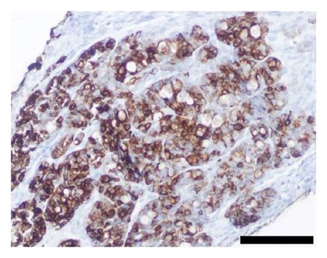 Histologic And Immunophenotypic Features Of Tlfck On Biopsy A Low