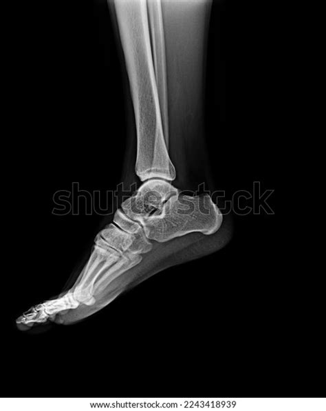 Xray Normal Human Foot Lateral View Stock Photo 2243418939 Shutterstock