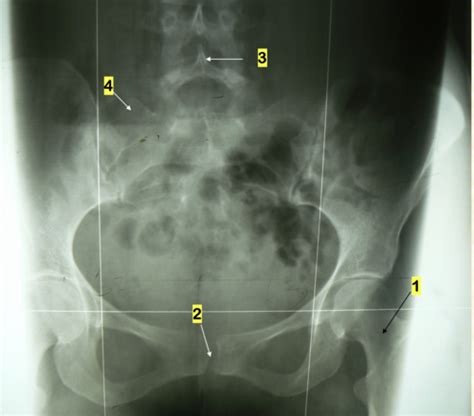 Full Spine Xray Analysis Review Flashcards Quizlet