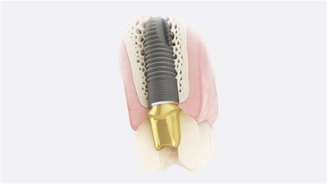 Single Tooth Implant Workflow Dentsply Sirona Mena