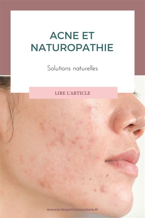 Acn Et Naturopathie Les Petits Pas Naturo Solutions Naturelles