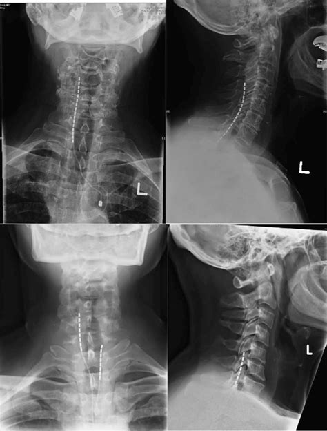 Anteroposterior And Lateral X Rays For Three Patients Showing Placement