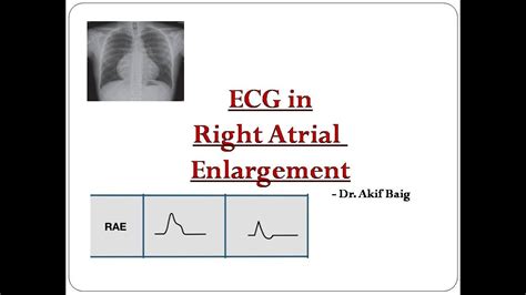 ECG In Right Atrial Enlargement In Atrial Fibrillation Dr Akif Baig