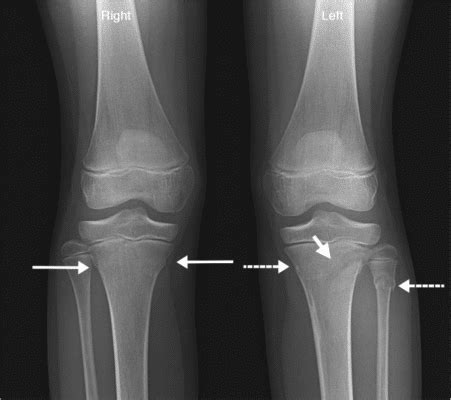 Buckle Fracture : Causes, Symptoms And Treatment