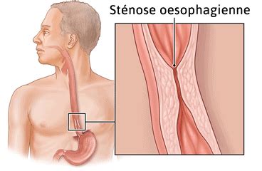 Complications Du Reflux Gastrique Oesophagite Ulc Re St Nose