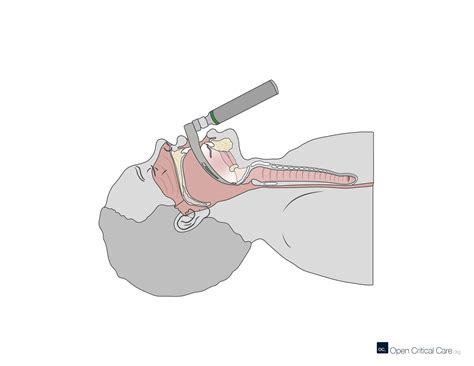 laryngoscope intubation method  jane shepherd blog