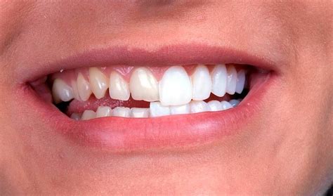 Qu Son Las Microcarillas Dentales Y Para Qu Sirven