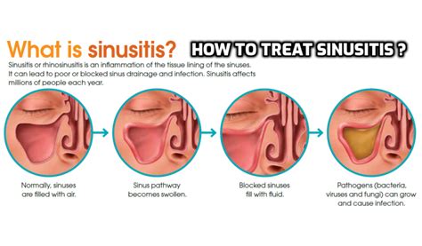 infection in the sinus cavities – Anti-Aging, Beauty, Health & Personal Care