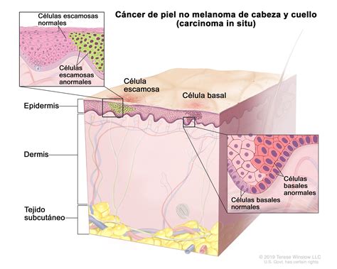 Tratamiento Del Cáncer De Piel Nci