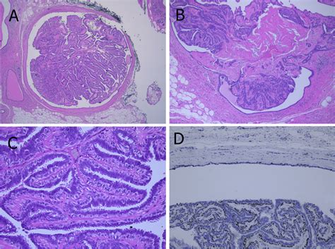 Papilloma In A Large Duct Central Location Showing Sclerotic Areas A