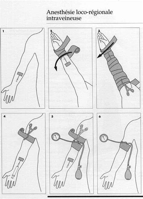 ALRIV Anesthésie Locale intraVeineuse Société Française des