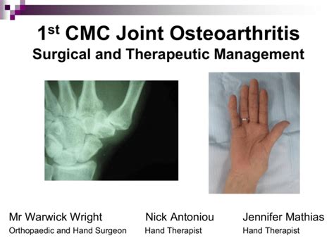 1st CMC Joint Osteoarthritis