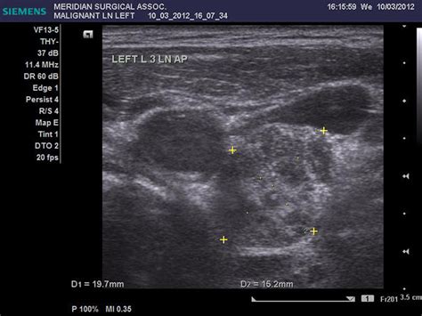 Thyroid Biopsy By Alexander Shifrin Md Thyroid