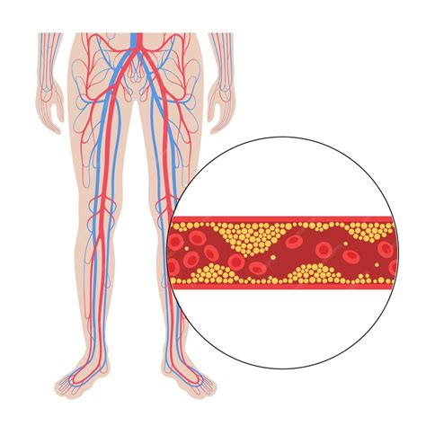 Premium Vector Peripheral Artery Disease