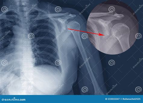 X-ray Shoulder Fracture Posterior Half of Glenoid with Posterior Dislocation of the Bone ...