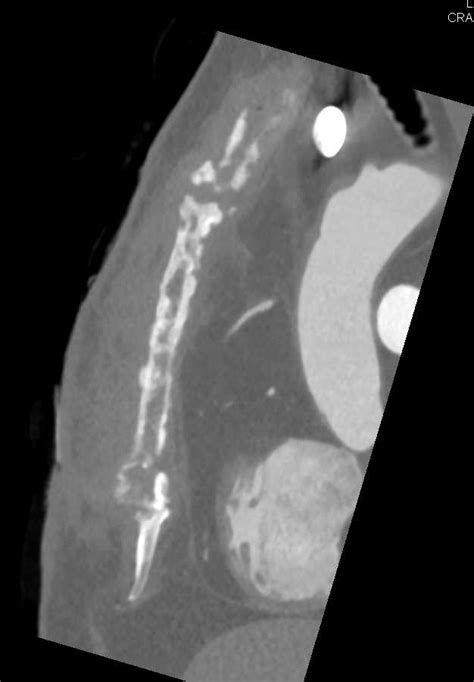 Sternal Osteomyelitis With Inflammation Musculoskeletal Case Studies