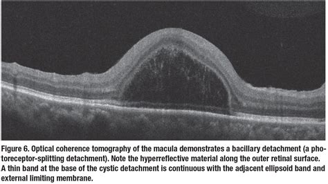 Retinal Tear Oct