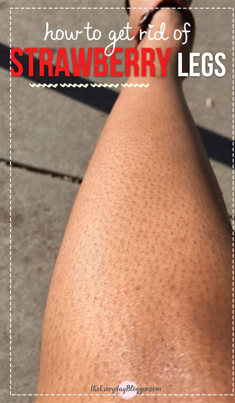 How To Get Rid Of Strawberry Legs In 5 Easy Steps Berita Viral