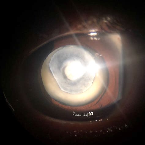 Congenital Multiple Level Lens Opacity American Academy Of Ophthalmology