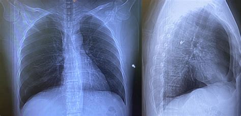 Pneumothorax Vs Atelectasis