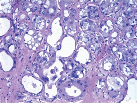 Adenosis And Sclerosing Lesions Oncohema Key