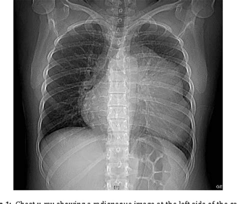 Figure From Giant Mature Cystic Teratoma Of The Mediastinum Resected