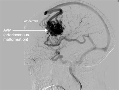 Arteriovenous Malformation Brain Avm Causes Symptoms Treatment