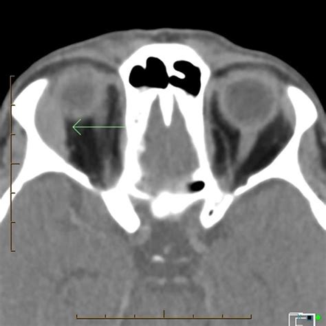 Lacrimal Gland Lymphoma Large Well Defined Extra